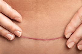 belly fat after hysterectomy